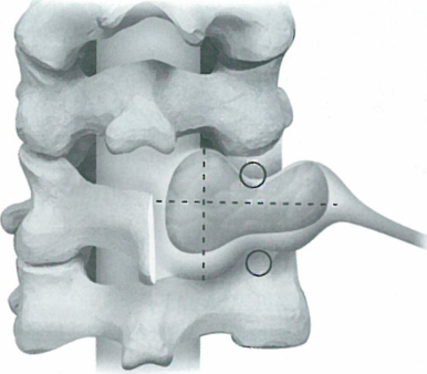 累及椎间孔的颈椎神经鞘瘤研究