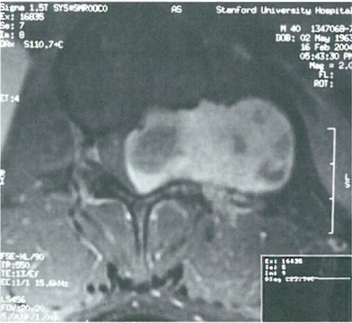 L1推体的哑钤型舯瘤病例研究