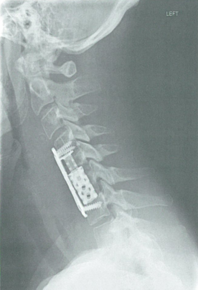 单一节段椎体切除术后的生物力学稳定性研究