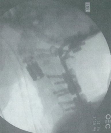 单一节段椎体切除术后的生物力学稳定性研究