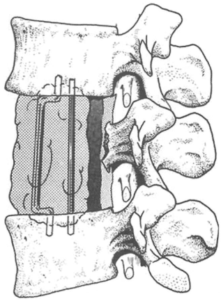 在转移癌手术中应用骨水泥（PMMA)重建的研究