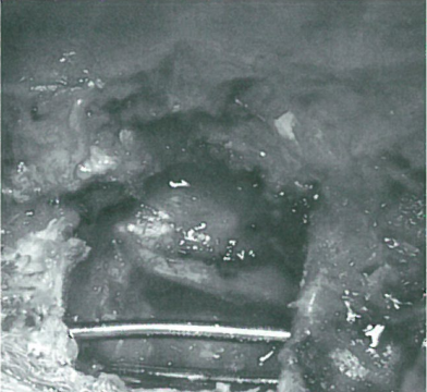 在转移癌手术中应用骨水泥（PMMA)重建的研究