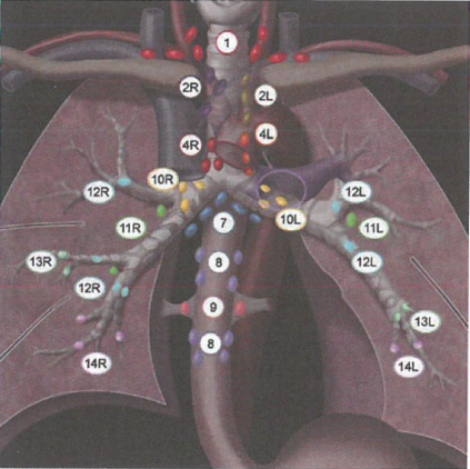 肺癌淋巴结分组和转移途径