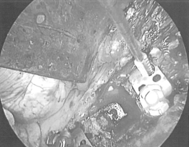 肿瘤切除（推体切除术）和植骨