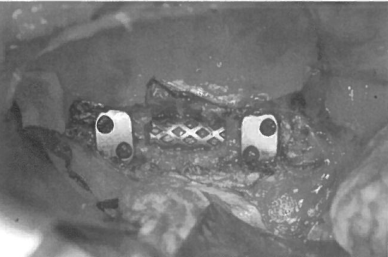 肿瘤切除（推体切除术）和植骨