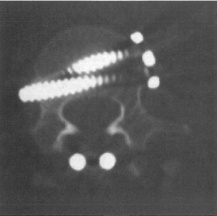 肿瘤切除（推体切除术）和植骨