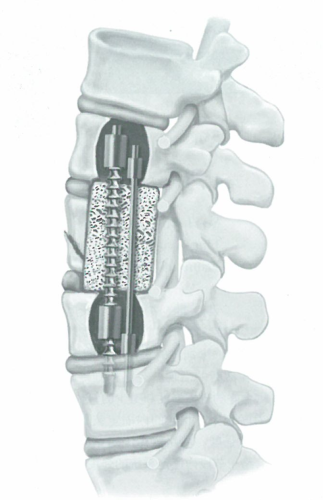 肿瘤切除前路内固定