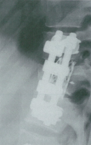 肿瘤切除前路内固定