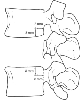 肿瘤切除（推体切除术）和植骨