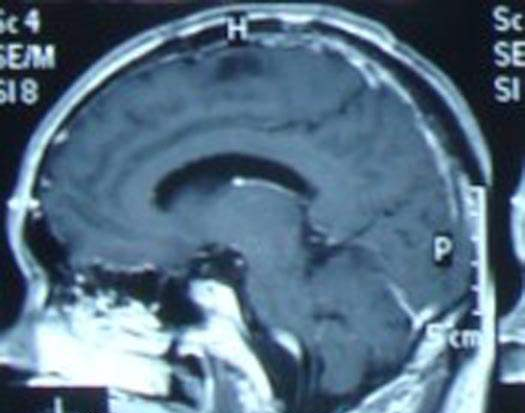 脑转移瘤中VEGF的信号及功能
