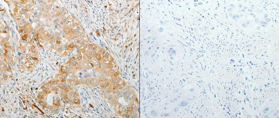肺癌基于蛋白层面的IHC法
