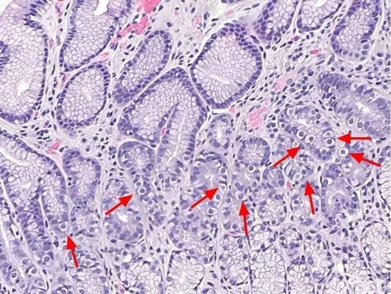 免疫炎症细胞是肿瘤的通用组分及运作方式