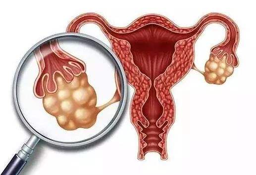 HPV与宫颈癌的风险程度相关
