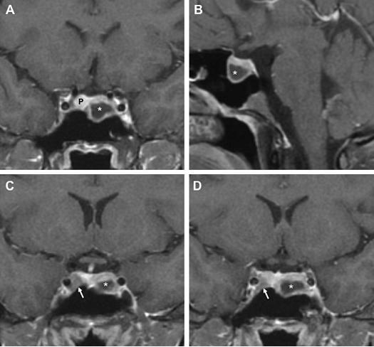家族性孤立性垂体腺瘤