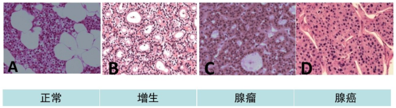 甲状旁腺功能亢进-颌骨肿瘤综合征