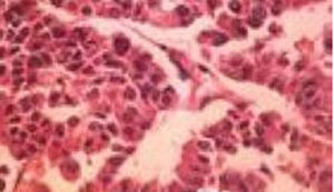 2A型和2B型多发性内分泌腺瘤病