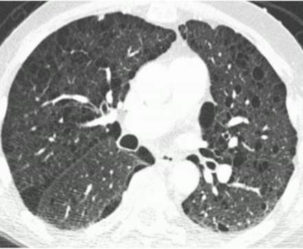 Birt-Hogg-Dub6(BHD)综合征有哪些？