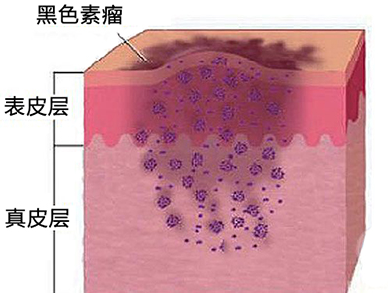黑色素瘤有效治疗的影响