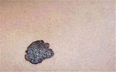 黑色素瘤有效治疗的影响