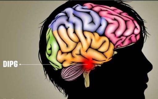 儿童低级别胶质瘤