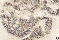 黑色素瘤的遗传和分子的认识及其对治疗的影响