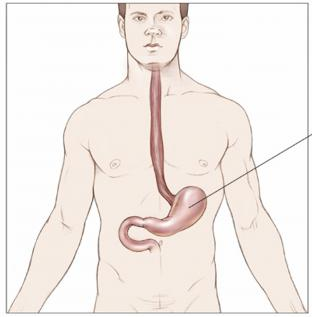 胃肠道网患者患神经内分泌肿瘤（NET）的生存率统计数据的研究