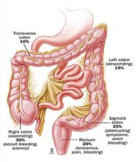 肛门癌筛查的总体​作用