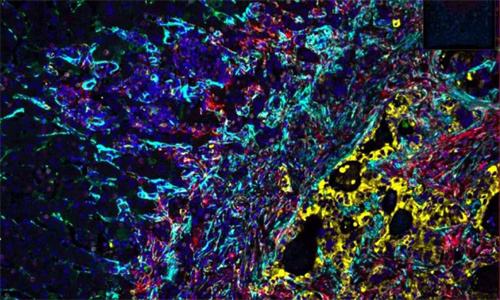 大肠癌肝转移周围的胶囊是肝脏的愈合反应