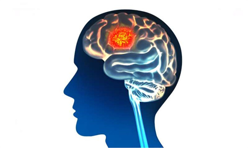 科学家正利用人工智能来预测脑癌症结果