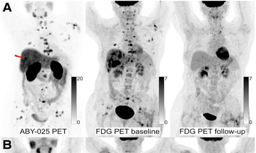 PET/CT 预测转移性乳腺癌患者靶向治疗的反应