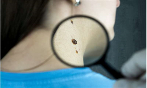 海外专家正在研究攻克皮肤癌的相关治疗情况