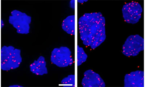 海外专家正利用新策略来攻击难治性淋巴瘤