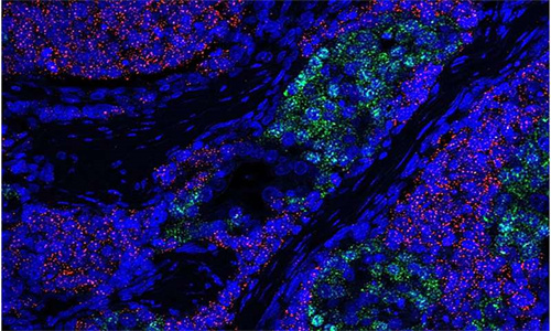研究描述了前列腺癌如何更具侵略性地生长