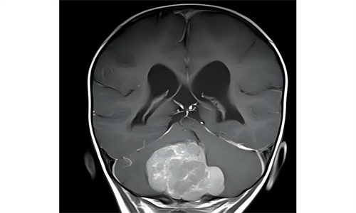 儿童脑瘤：癌细胞在肿瘤内迁移时攻击性降低