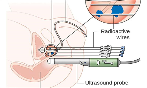 放射疗法利用了癌症较差的 DNA 修复能力