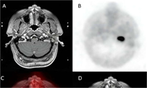 低风险 MDS 建议使用依美特司他治疗症状性贫血